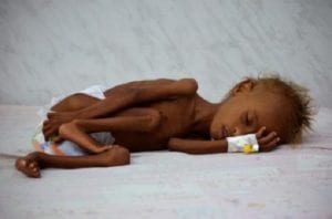 وكالات:أكثر من مليون طفل يمني يعانون الجوع