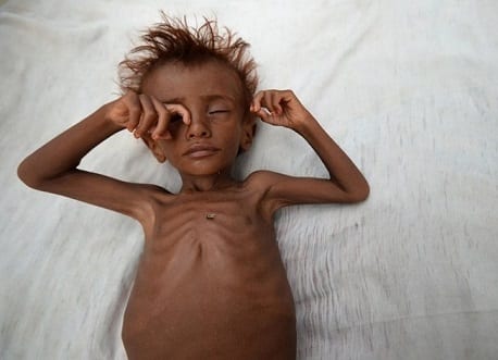 الاطفال يموتون في اليمن