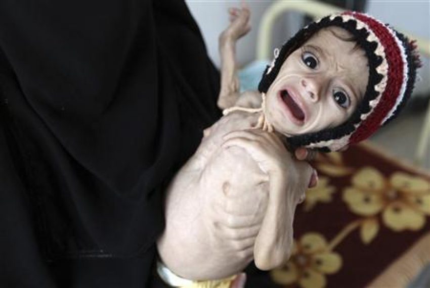اليمن يواجه "أكبر مأساة إنسانية في العالم"