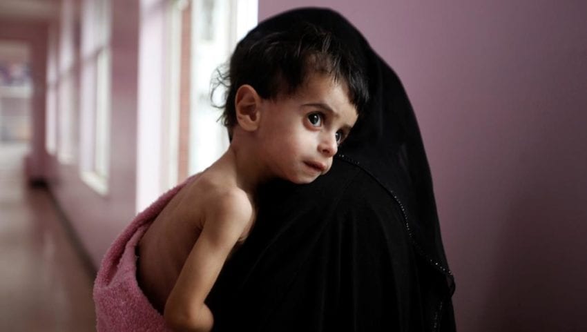 الصحة العالمية: دعمٌ إيطاليٌ لإنقاذ خمسين ألف طفل في اليمن
